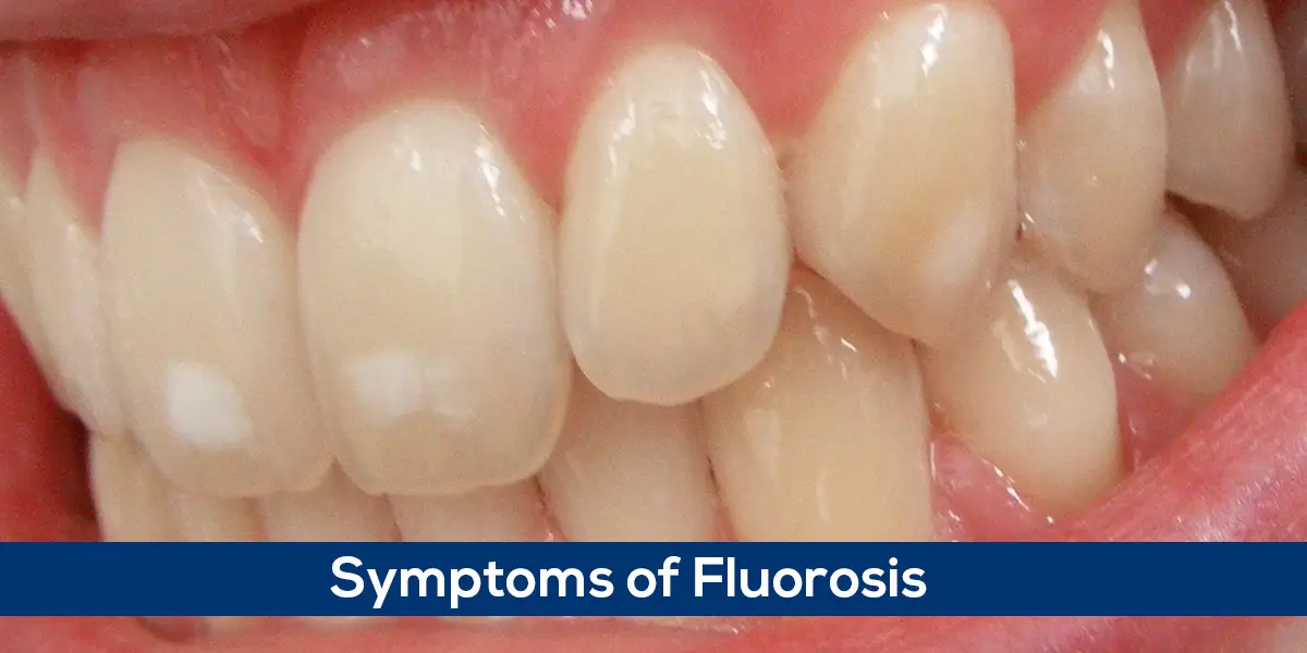 Fluorosis – Symptoms of Fluorosis